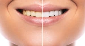 Before After Cosmetic Dentistry Photos
