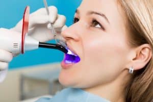 Dental Composite Bonding Beverly Hills