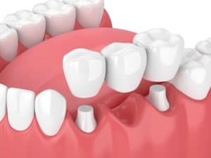 Dental Bridge Procedure Beverly Hills