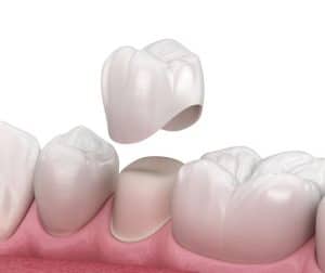 Dental Crowns Beverly Hills