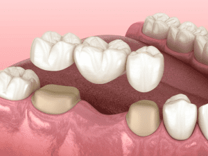 Full Mouth Restoration Beverly Hills