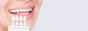Porcelain Veneers Beverly Hills