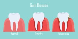 Periodontal Treatment Beverly Hills