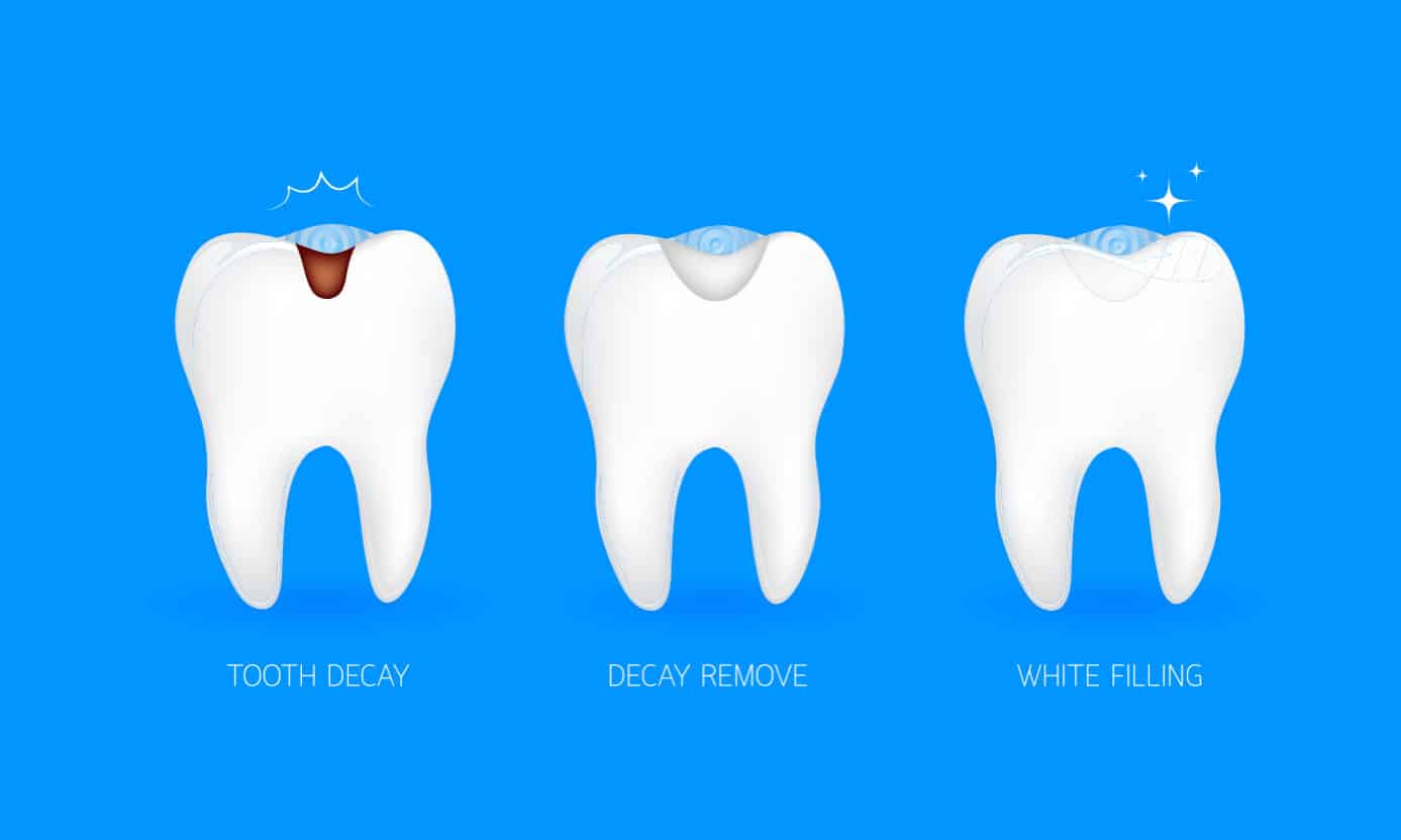 Tooth-Colored Fillings Beverly Hills